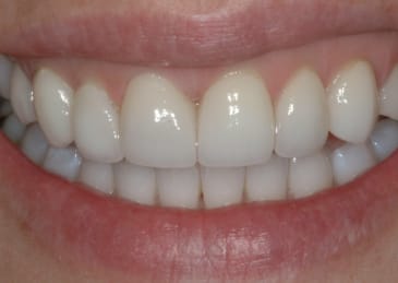 teeth after veneers- straight and white