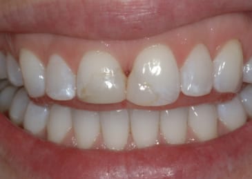 Teeth before veneers - yellow stains and some cracks