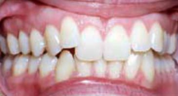 before invisalign-some teeth are angled upward