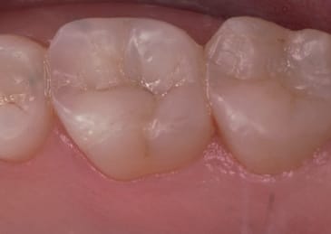 after removing silver fillings- tooth looks natural