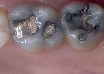 before removing silver fillings